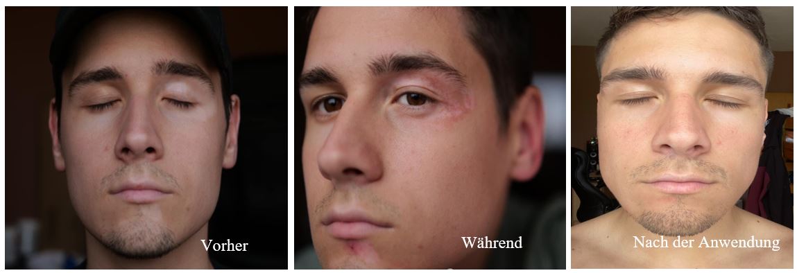 Vitiligo-Repigmentierung