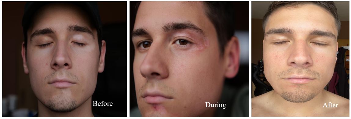 Vitistop Gel Results