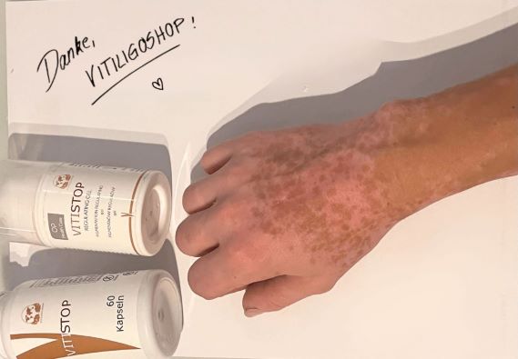 Repigmentierung mit Vitistop-Gel