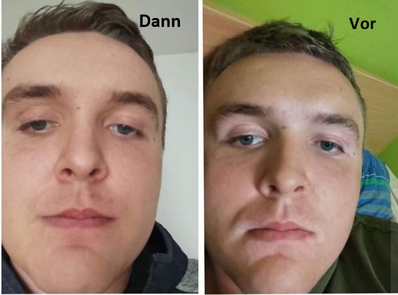 UVB-Lampe Dermalight