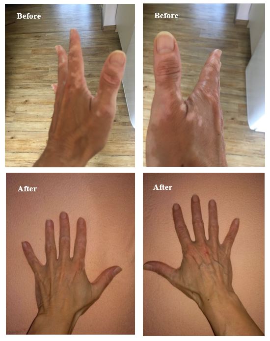 Vitiligo repigmentation results