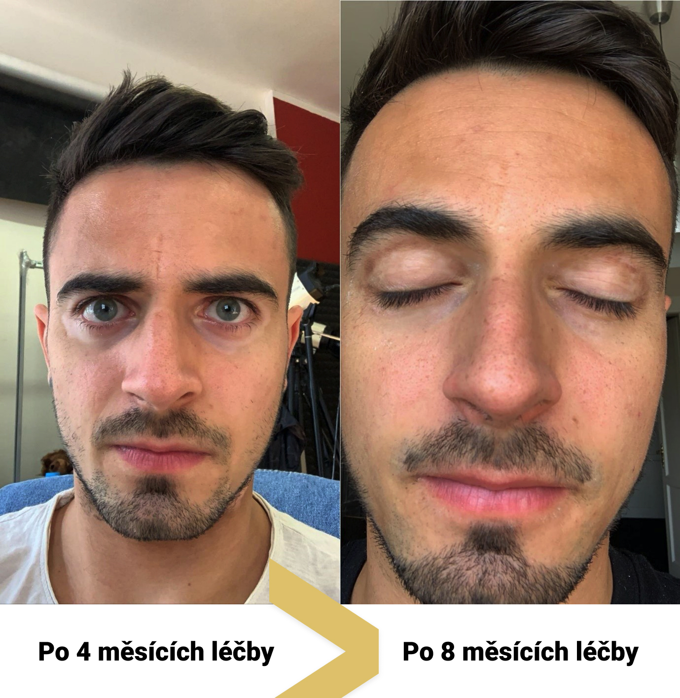 Léčba vitiliga UVB lampou Dermalight