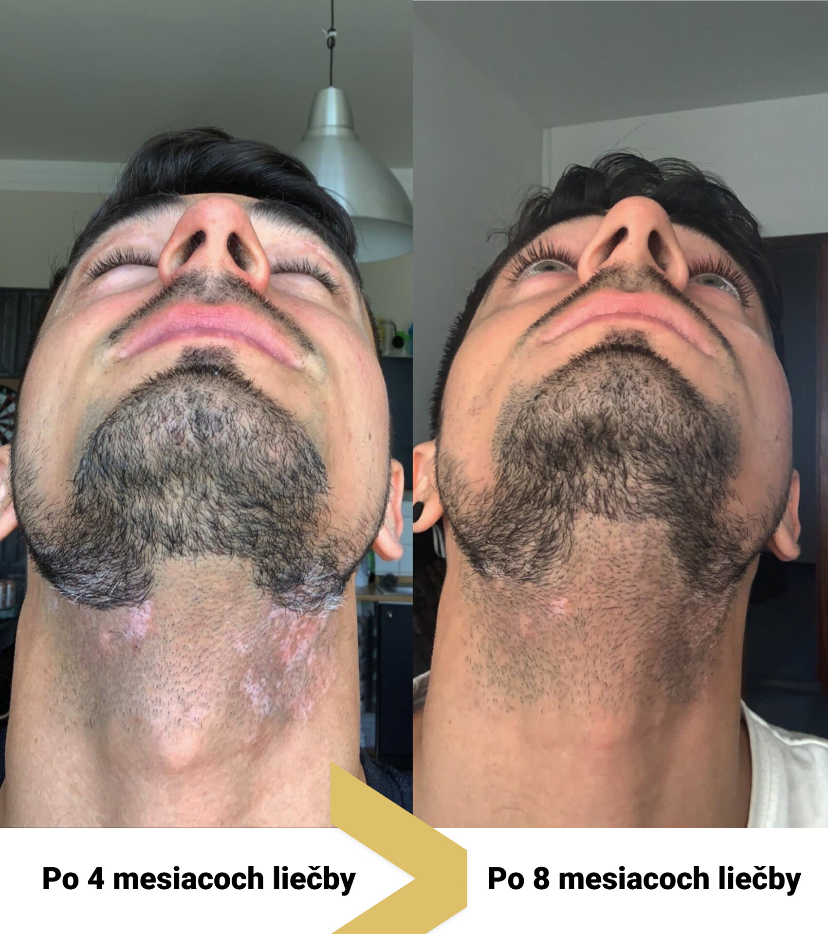 vitiligo repigmentacia