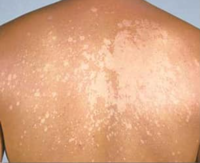 pityriasis