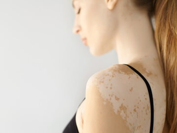 vitiligo-diagnozisa
