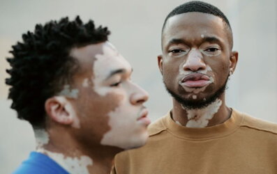 Vitiligo in der mode
