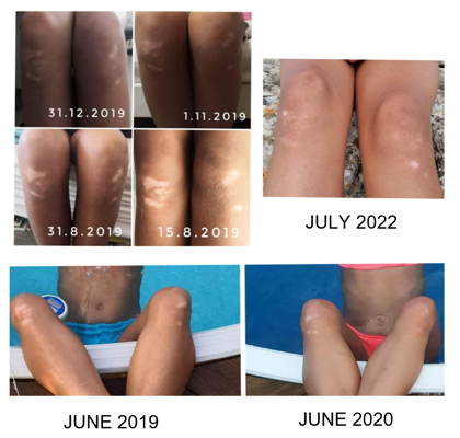Vitiligo in children - result