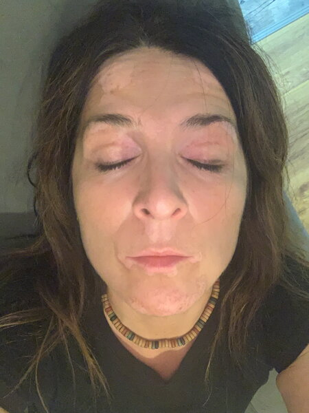 Vitiligo-Repigmentierung Vorher