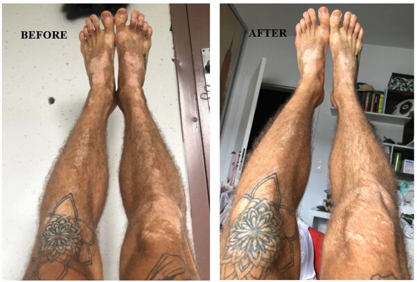 Legs showing vitiligo repigmentation