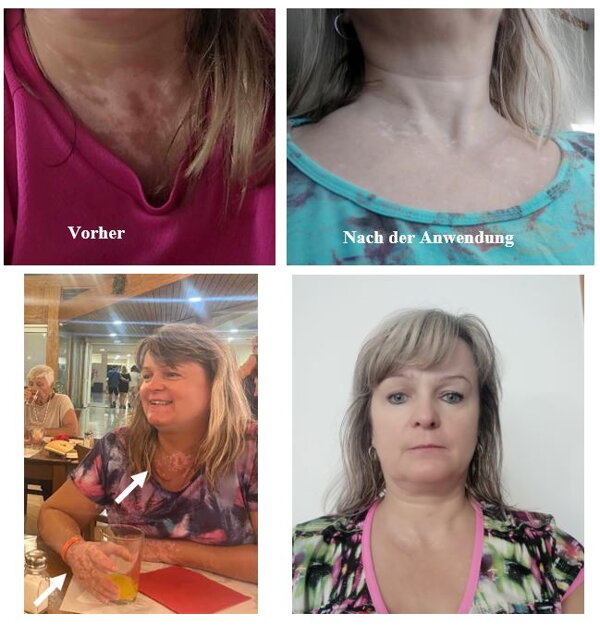Vitiligo Repigmentierung