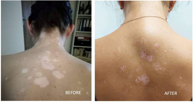 Vitistop Gel results