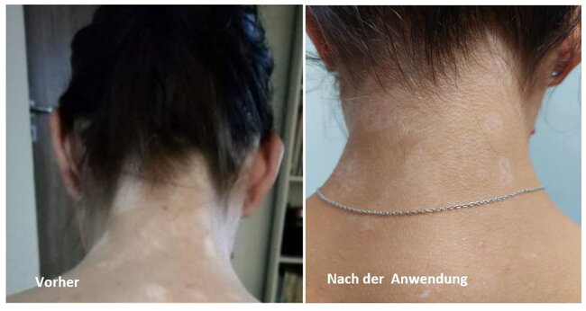 Vitiligo-Repigmentierung Hals