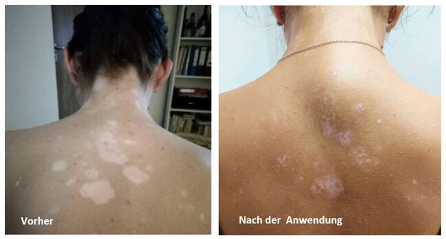 Vitiligo-Repigmentierung Gesicht