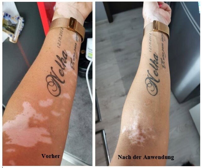 Vitiligo-Ergebnisse