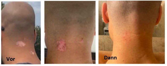 UVB-Lampe Dermalight