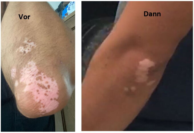 Vitipro-Gel Anwendung