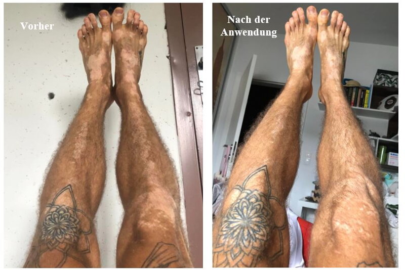 Vitistop-Gel Anwendung Mann