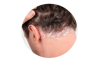 Stres a jeho dopad na PSORIAZU| Psoriashop.sk