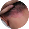 PSORIÁZA liečba 2024 a jej možnosti | Psoriashop.sk