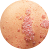 PSORIAZA a liečba | Psoriashop.sk