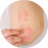 LIEČBA SVETLOM | Dermalight® 80 | UVB lampa na psoriázu